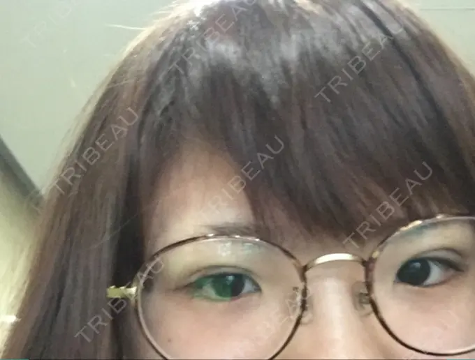 二重埋没 湘南美容クリニック 京都院 DAY 0 メイン用