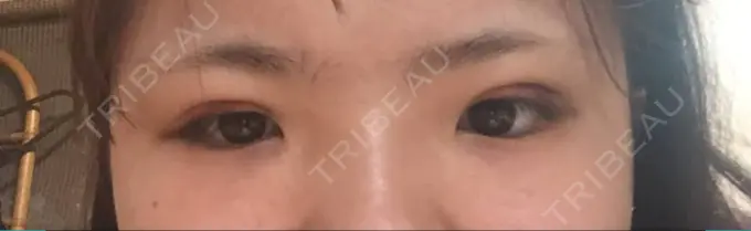 二重埋没 湘南美容クリニック 京都院 DAY 0 メイン用