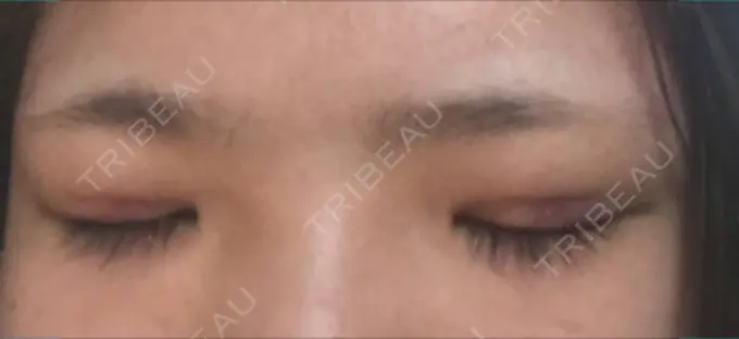 二重埋没 湘南美容クリニック 京都院 DAY 0 メイン用