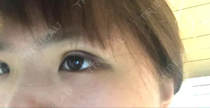 二重埋没 湘南美容クリニック 京都院 DAY 1 メイン用