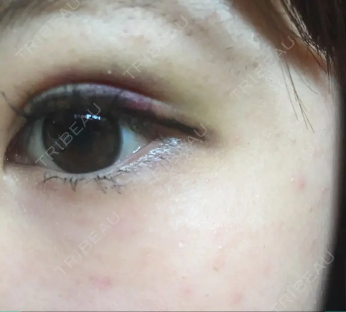 二重埋没 湘南美容クリニック 京都院 AFTER メイン用