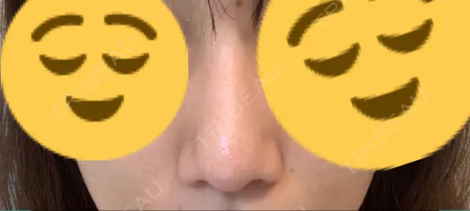 鼻尖形成（切開） / 軟骨移植 THE ROPPONGI CLINIC（ザ 六本木クリニック） DAY 44 メイン用