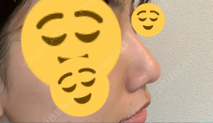 鼻尖形成（切開） / 軟骨移植 THE ROPPONGI CLINIC（ザ 六本木クリニック） DAY 44 メイン用