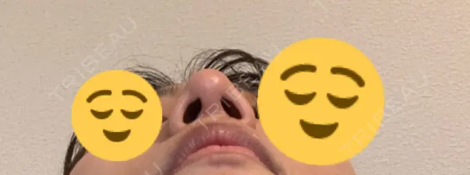 鼻尖形成（切開） / 軟骨移植 THE ROPPONGI CLINIC（ザ 六本木クリニック） DAY 44 メイン用