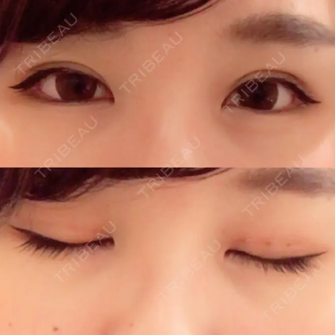 二重埋没 湘南美容クリニック 大阪あべの院 DAY 4 メイン用