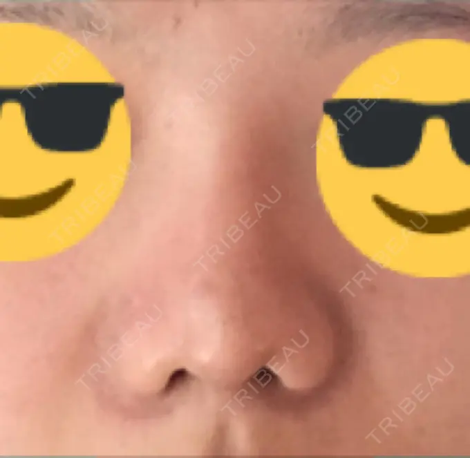 隆鼻術 / 鼻中隔延長（切開） / 鼻尖縮小 みずほクリニック DAY 52 メイン用