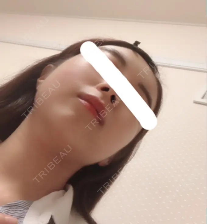 骨削り（頬） ボンディ美容整形外科（旧リオン整形外科） DAY 179 メイン用