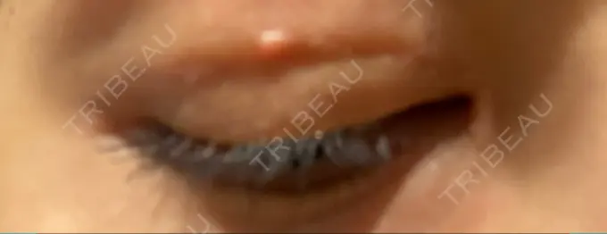 二重切開 / 目頭切開 きくな湯田眼科 DAY 118 メイン用