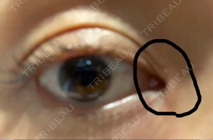 二重切開 / 目頭切開 きくな湯田眼科 DAY 118 メイン用