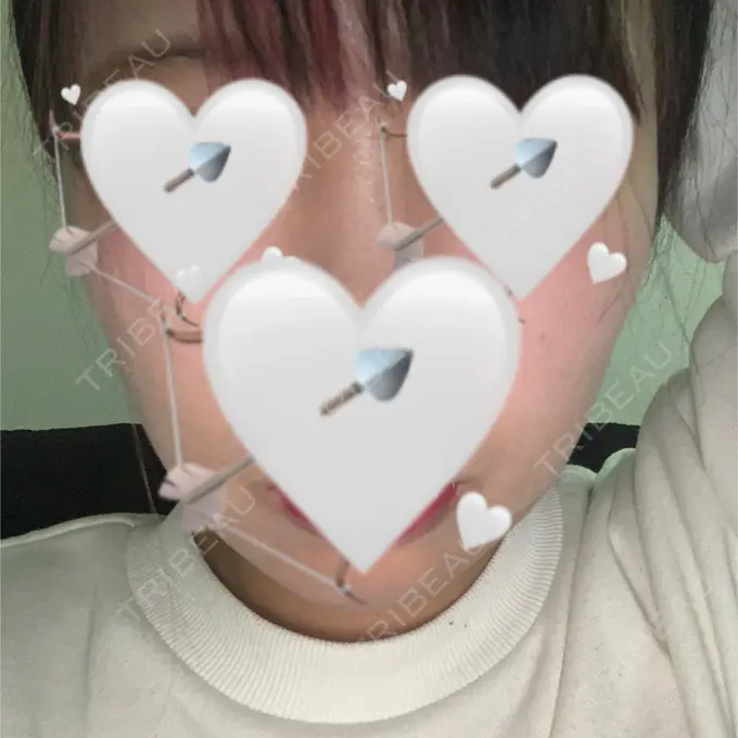 脂肪吸引（顔） ガーデンクリニック 名古屋院 DAY 9 メイン用