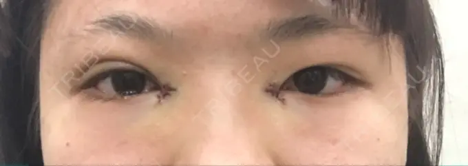 二重埋没 / 目頭切開 湘南美容クリニック 京都院 DAY 1 メイン用