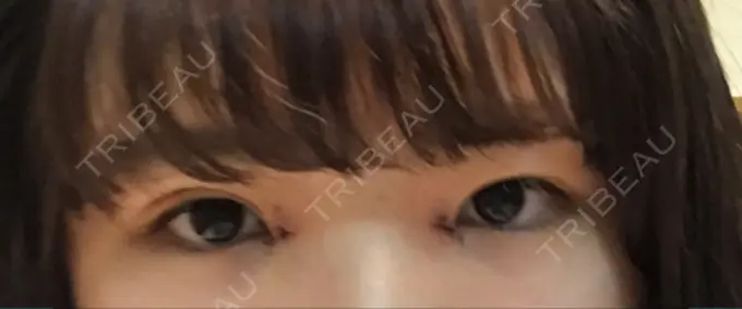 二重埋没 / 目頭切開 湘南美容クリニック 京都院 DAY 5 メイン用