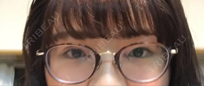 二重埋没 / 目頭切開 湘南美容クリニック 京都院 DAY 5 メイン用