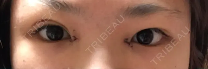 二重埋没 / 目頭切開 湘南美容クリニック 京都院 DAY 6 メイン用