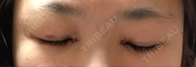 二重埋没 / 目頭切開 湘南美容クリニック 京都院 DAY 6 メイン用