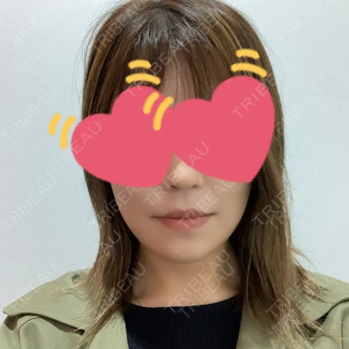 糸リフト / バッカルファット除去 / 脂肪吸引（顔） / メーラーファット除去 / ボトックス（エラ・小顔） 湘南美容クリニック 秋葉原院 DAY -67 メイン用