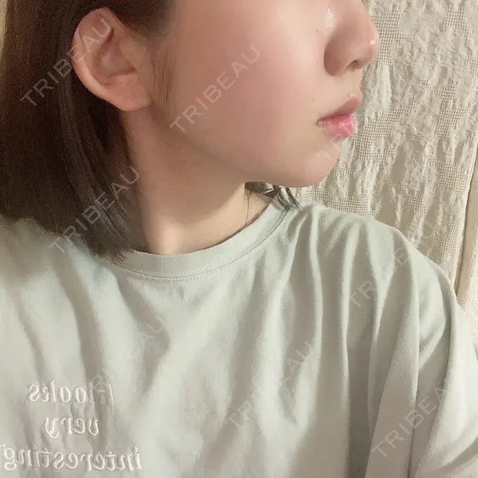 糸リフト / 肌ヒアルロン酸注入（たるみ・シワ改善） / ボトックス（エラ・小顔） TCB東京中央美容外科 新宿東口院 DAY 19 メイン用