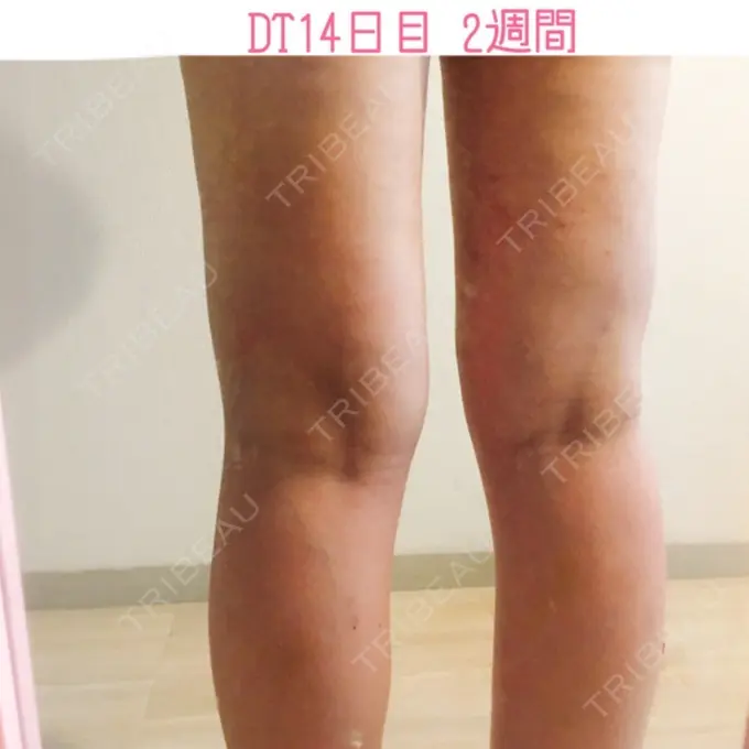 脂肪吸引（脚） / 脂肪吸引（お腹） / 脂肪吸引（お尻） ヨンセスリムライン DAY 14 メイン用