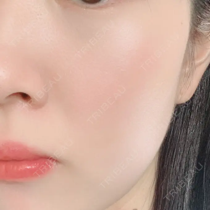 ほくろ・いぼ切除（肌） 品川スキンクリニック大宮院 DAY 70 メイン用