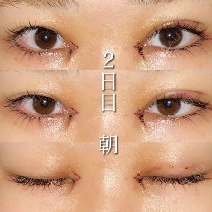 目尻切開 湘南美容クリニック 橋本院 DAY 2 メイン用