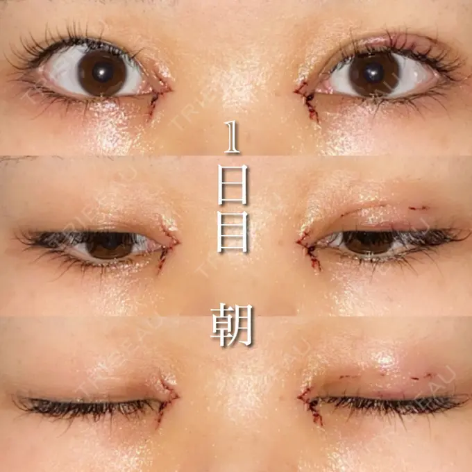 目尻切開 湘南美容クリニック 橋本院 DAY 1 メイン用
