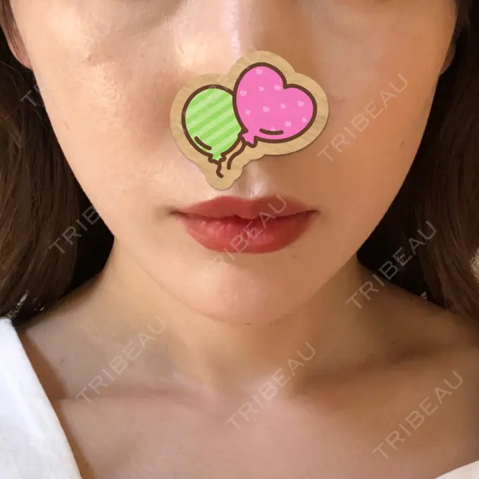 糸リフト / ヒアルロン酸注入（あご） / ボトックス（エラ・小顔） / 脂肪溶解注射（顔） 大阪TAクリニック AFTER メイン用