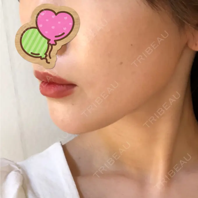 糸リフト / ヒアルロン酸注入（あご） / ボトックス（エラ・小顔） / 脂肪溶解注射（顔） 大阪TAクリニック DAY 39 メイン用