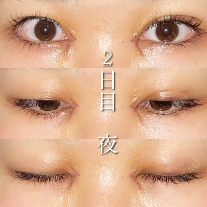 目尻切開 湘南美容クリニック 橋本院 DAY 2 メイン用