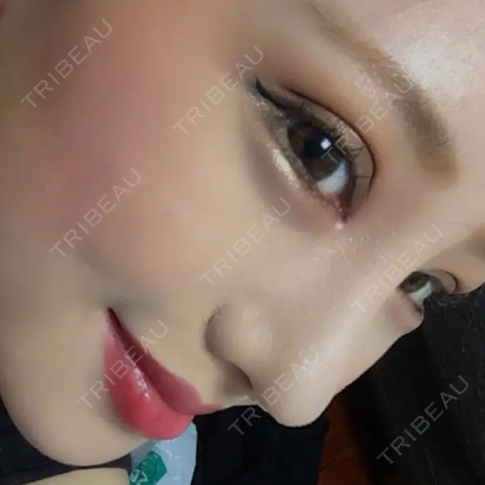 二重切開 / 目頭切開 / 眼瞼下垂（切開） / 隆鼻術 / 鼻尖形成（切開） / タレ目形成・グラマラスライン（切開） / 軟骨移植 / プロテーゼ除去 / 鼻修正 / 鼻尖縮小 / その他（鼻） グローバルビューティークリニック 大阪院 AFTER メイン用