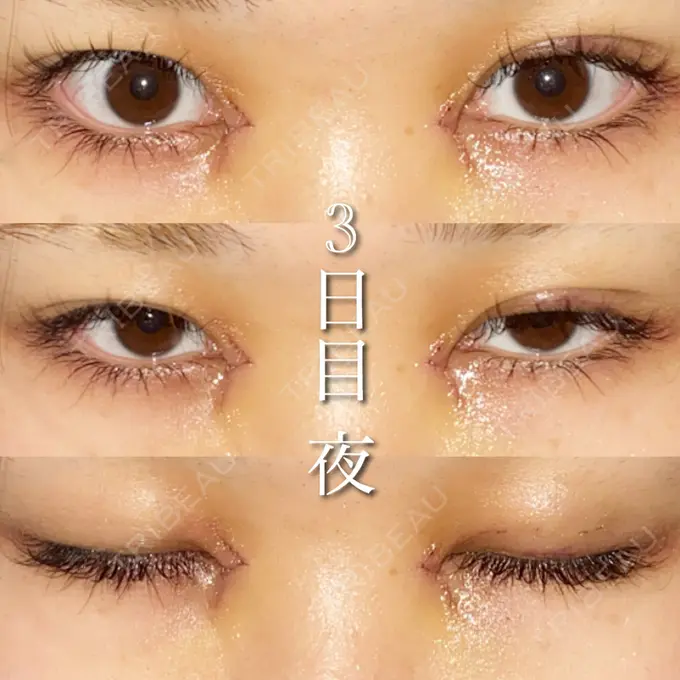目尻切開 湘南美容クリニック 橋本院 DAY 3 メイン用