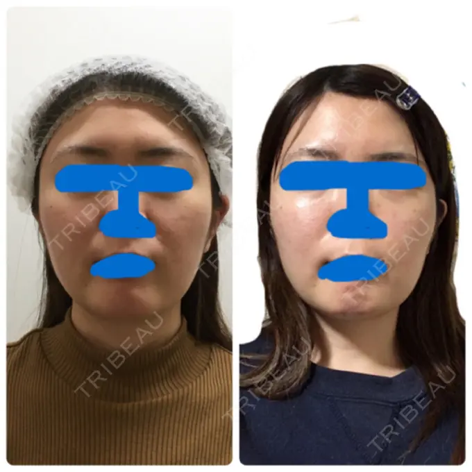 ハイフ（顔） 湘南美容クリニック 新宿本院 AFTER メイン用