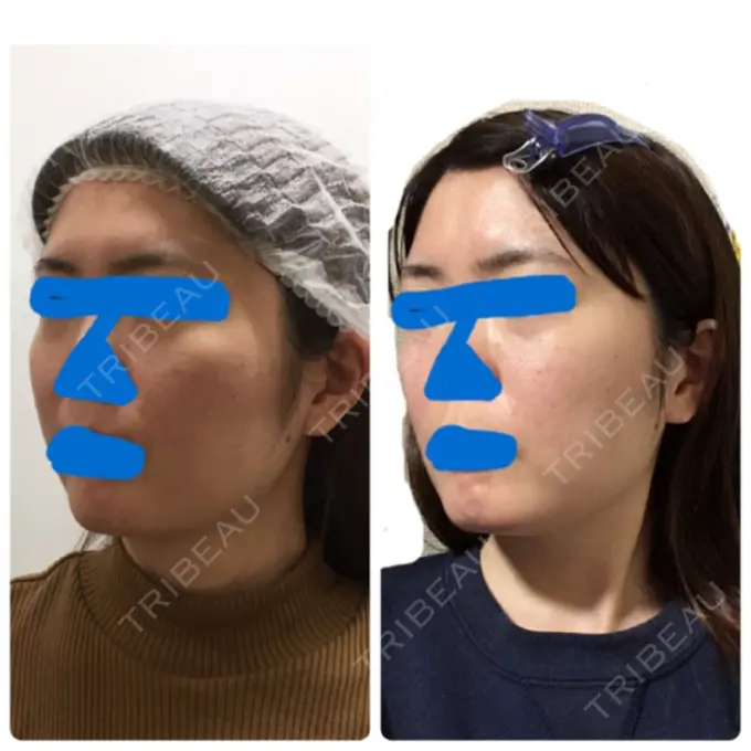 ハイフ（顔） 湘南美容クリニック 新宿本院 DAY 0 メイン用