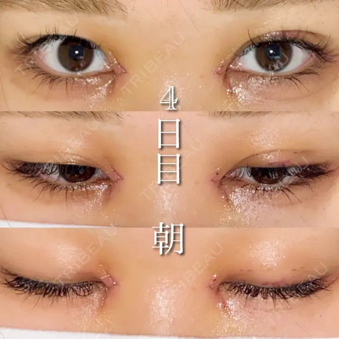 目尻切開 湘南美容クリニック 橋本院 DAY 4 メイン用