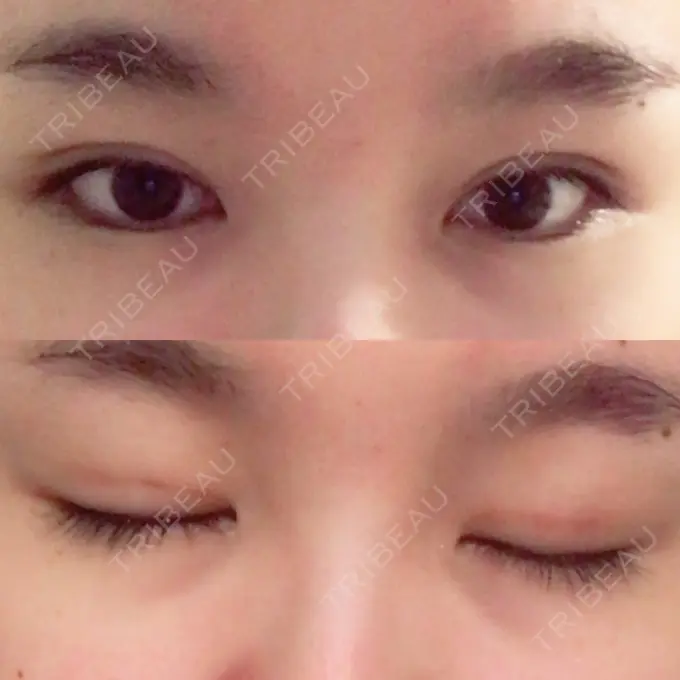 二重埋没 湘南美容クリニック 大阪あべの院 DAY 7 メイン用