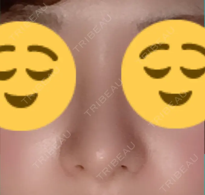 隆鼻術 / 鼻尖形成（切開） / 小鼻縮小（切開） / 軟骨移植 / 骨切幅寄せ ザ・プラス美容外科 DAY 52 メイン用