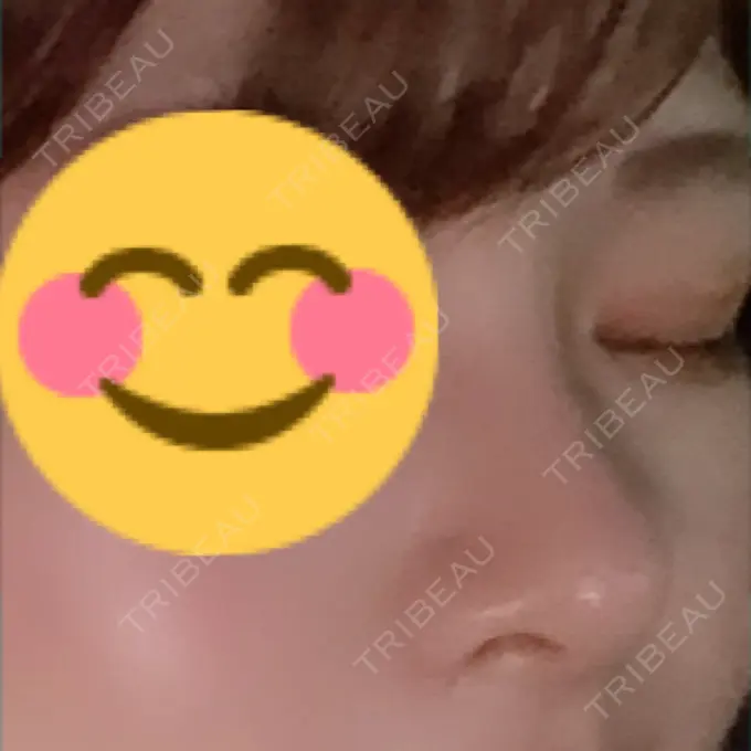 隆鼻術 / 鼻尖形成（切開） / 小鼻縮小（切開） / 軟骨移植 / 骨切幅寄せ ザ・プラス美容外科 DAY 52 メイン用