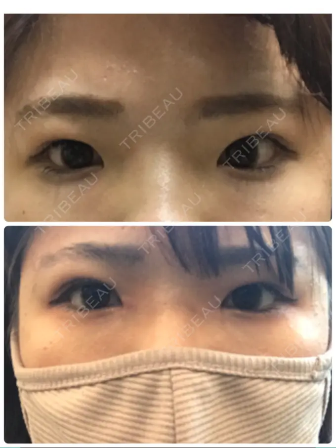 二重埋没 / 目頭切開 湘南美容クリニック 京都院 DAY 10 メイン用