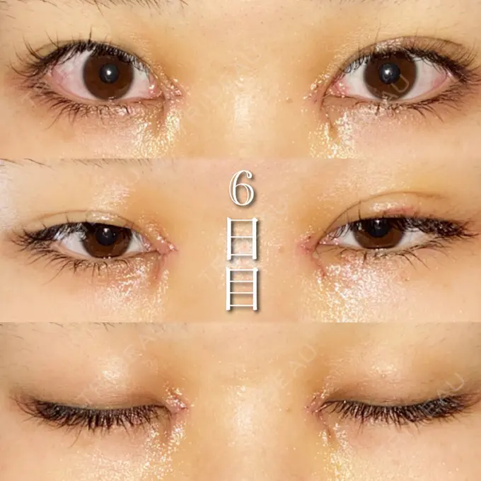 目尻切開 湘南美容クリニック 橋本院 DAY 7 メイン用