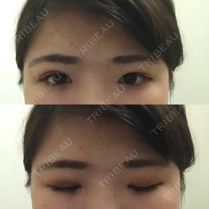 二重埋没 / 目頭切開 湘南美容クリニック 京都院 DAY 14 メイン用