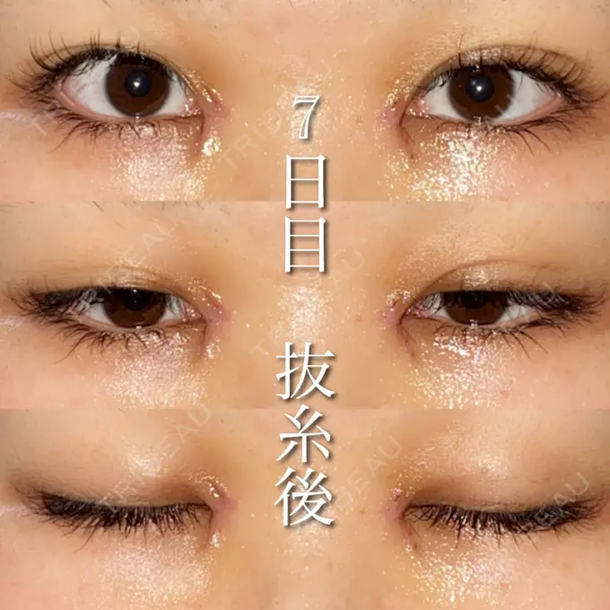 目尻切開 湘南美容クリニック 橋本院 AFTER メイン用