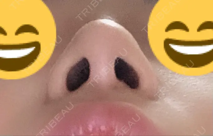 隆鼻術 / 鼻尖形成（切開） / 小鼻縮小（切開） / 軟骨移植 / 骨切幅寄せ ザ・プラス美容外科 DAY 463 メイン用