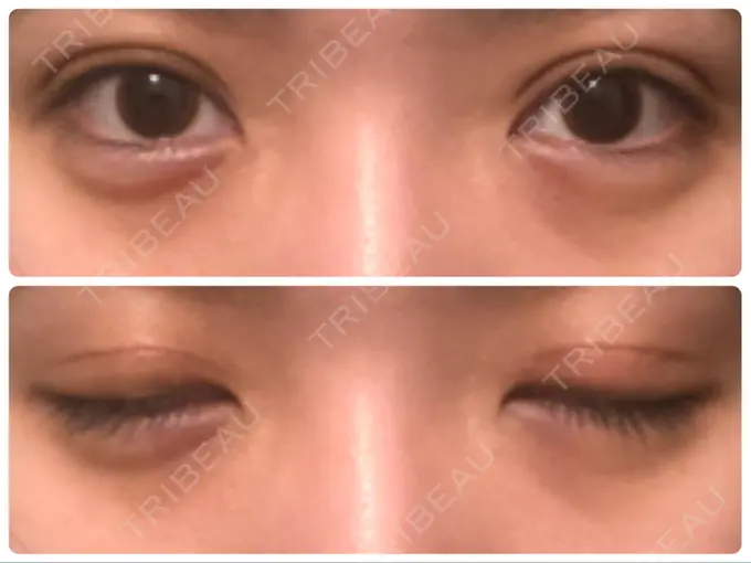 眼瞼下垂（切開） Taide Suenaga Clinic（タイデスエナガクリニック） DAY 73 メイン用