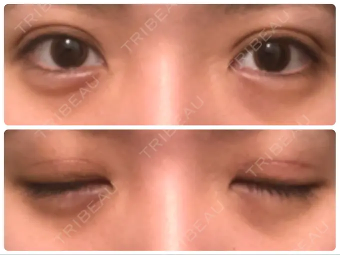 眼瞼下垂（切開） Taide Suenaga Clinic（タイデスエナガクリニック） DAY 76 メイン用