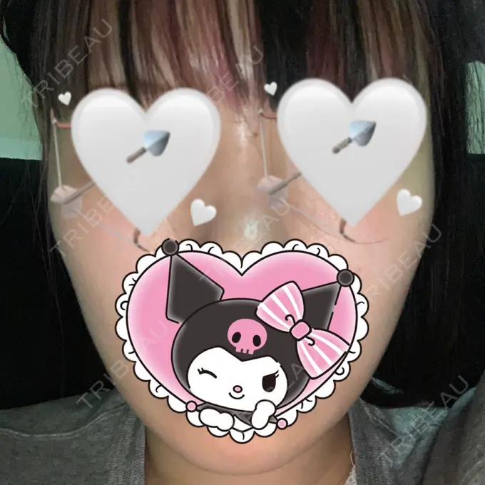 脂肪吸引（顔） ガーデンクリニック 名古屋院 DAY 21 メイン用