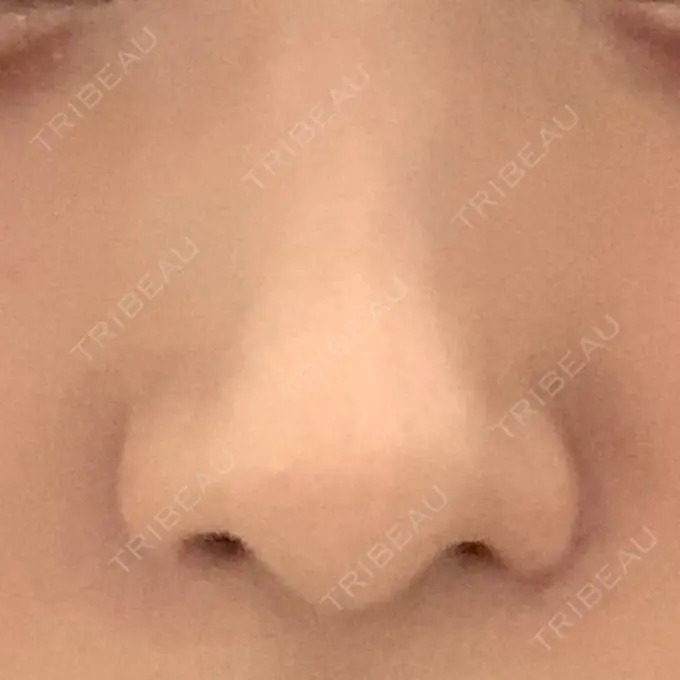 小鼻縮小（切開） / 鼻翼挙上 東京形成美容外科 船橋院 DAY 27 メイン用