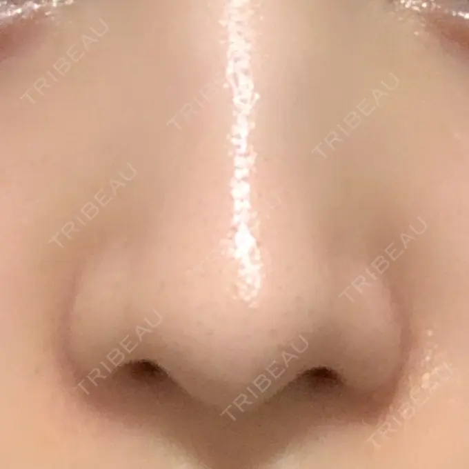 小鼻縮小（切開） / 鼻翼挙上 東京形成美容外科 船橋院 AFTER メイン用