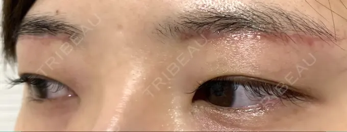 上まぶたの脂肪取り / 眉下切開 城本クリニック 福岡院 DAY 28 メイン用