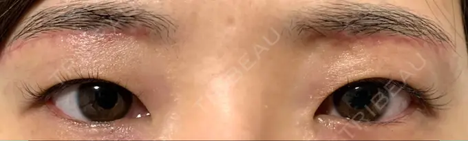 上まぶたの脂肪取り / 眉下切開 城本クリニック 福岡院 DAY 28 メイン用