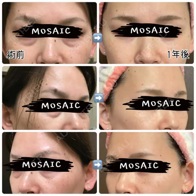 豊胸（脂肪注入） / 胸修正 / 脂肪注入（額） THE CLINIC（ザ・クリニック） 大阪院 DAY 381 メイン用