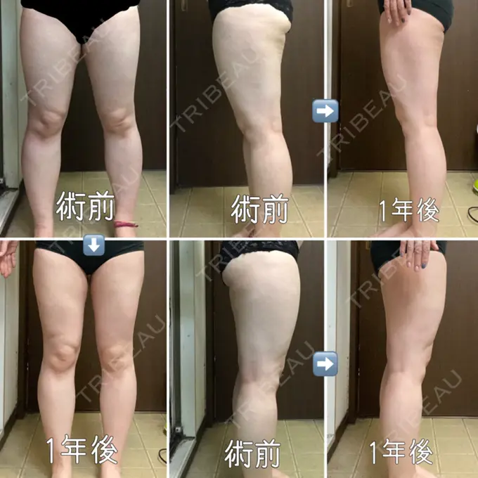 豊胸（脂肪注入） / 胸修正 / 脂肪注入（額） THE CLINIC（ザ・クリニック） 大阪院 DAY 381 メイン用